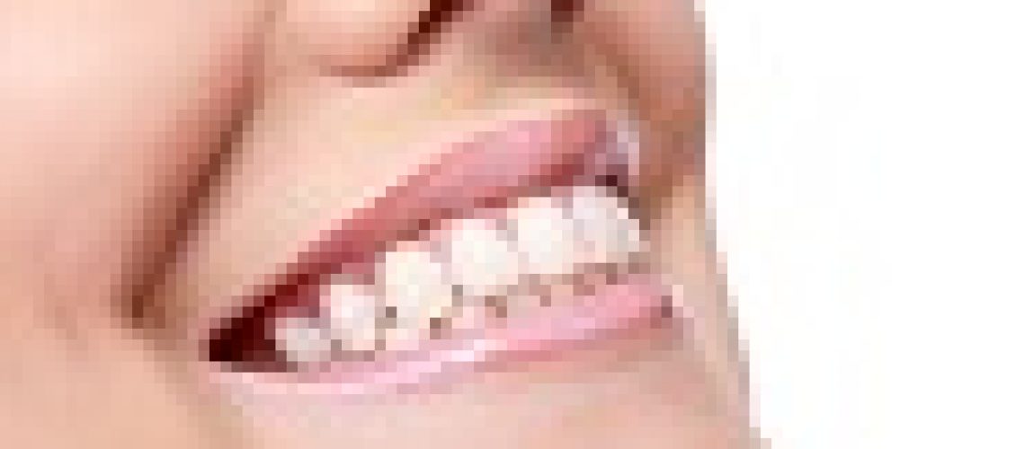 יישור שיניים גשר שקוף -  מה צריך לברר לפני הטיפול